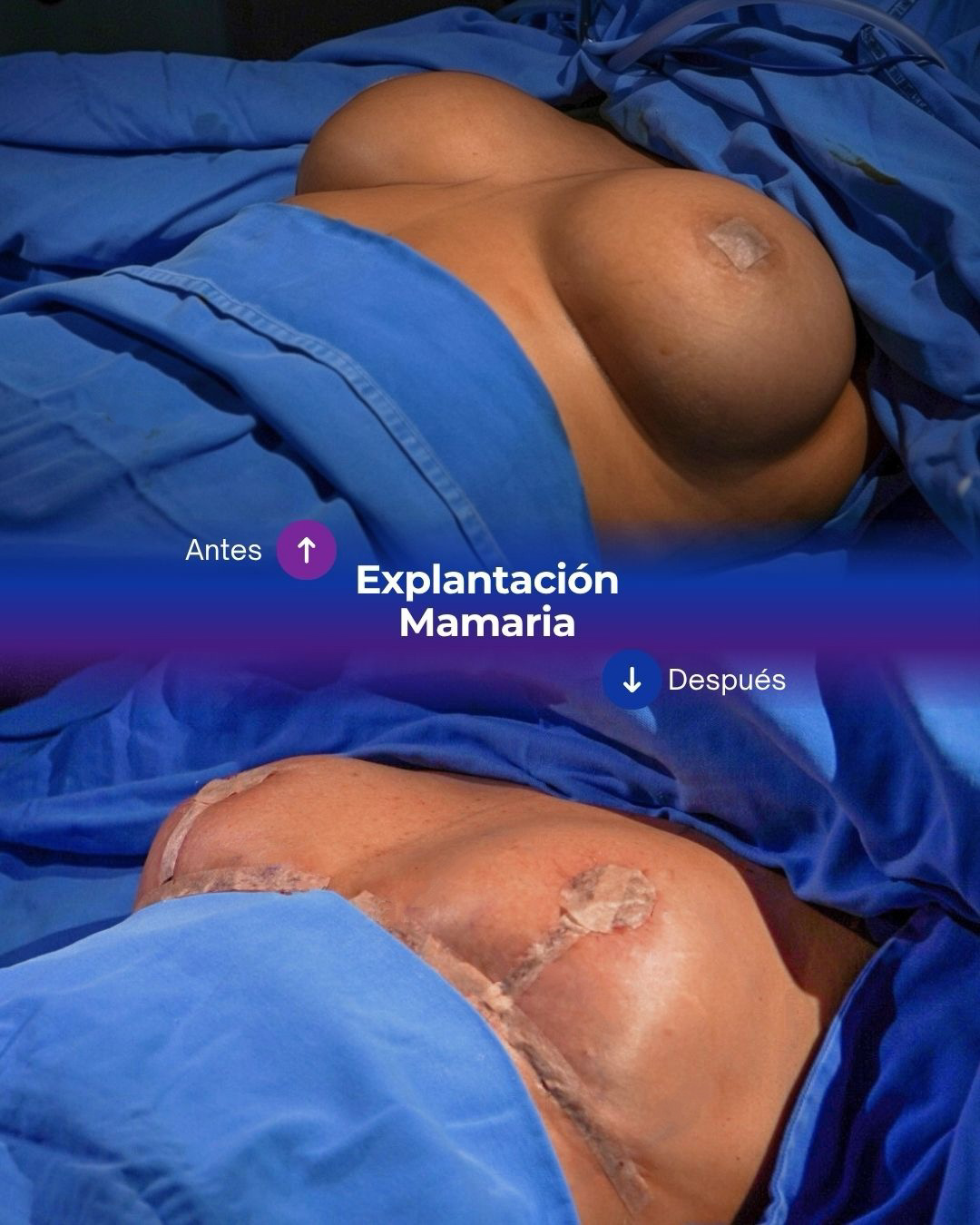 Explantación post antes y después (Post para Instagram (4:5))