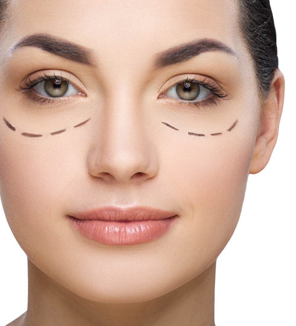 blefaroplastia.jpg
